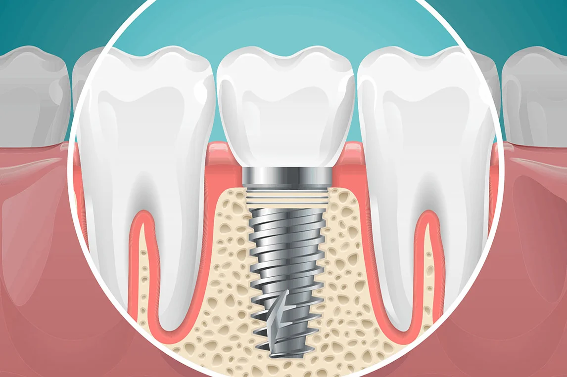 Implant