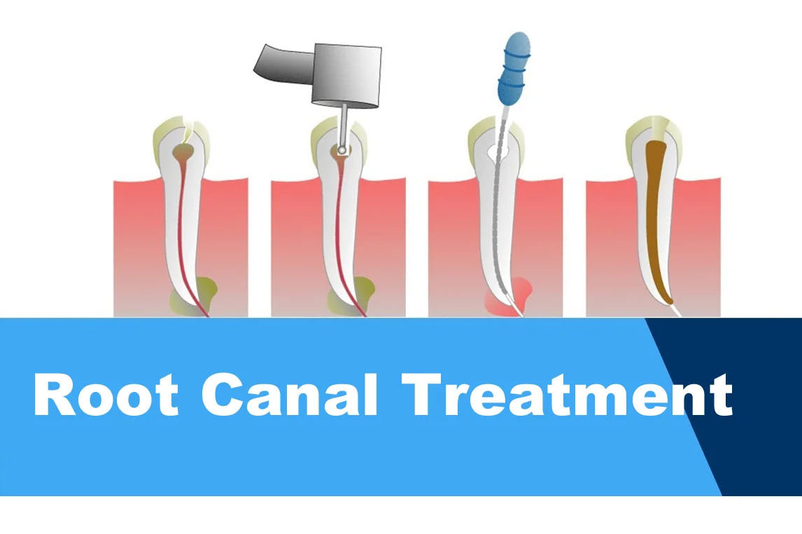 Painless RCT