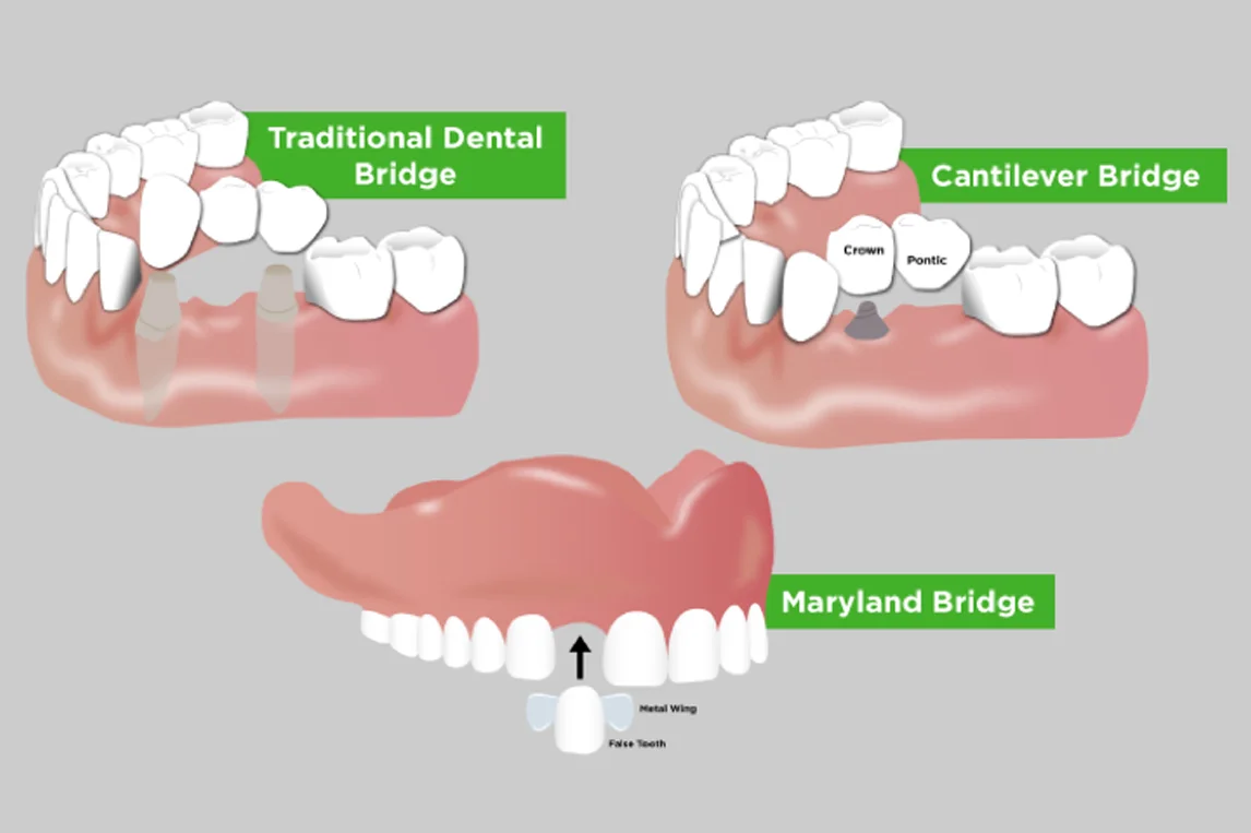 Bridges