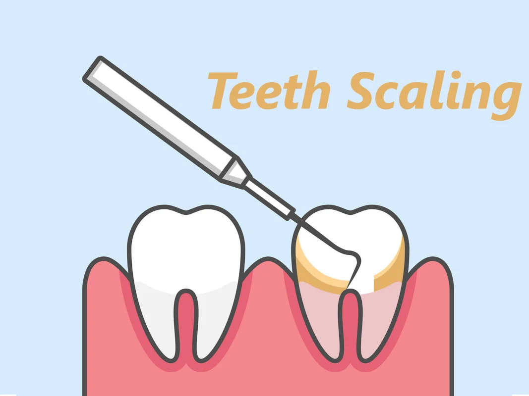 Scaling & Polishing