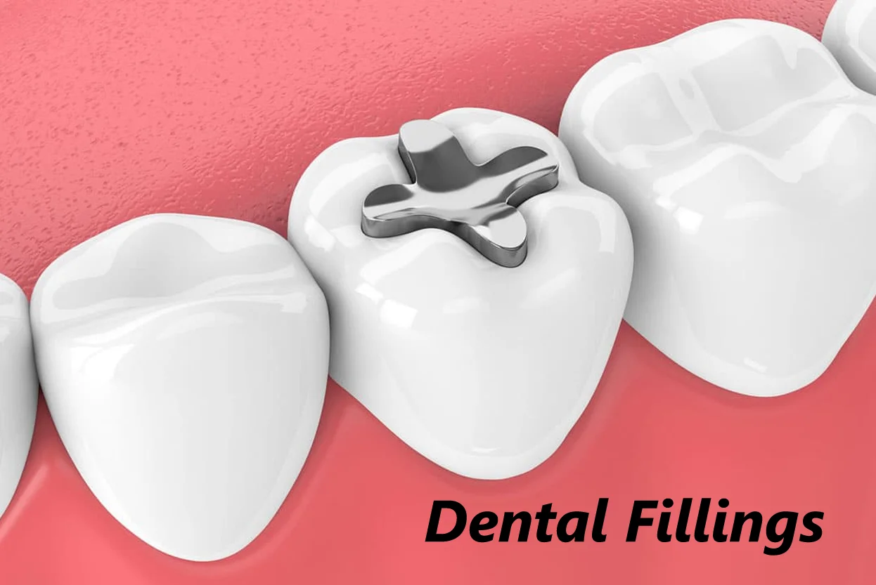 Dental Fillings