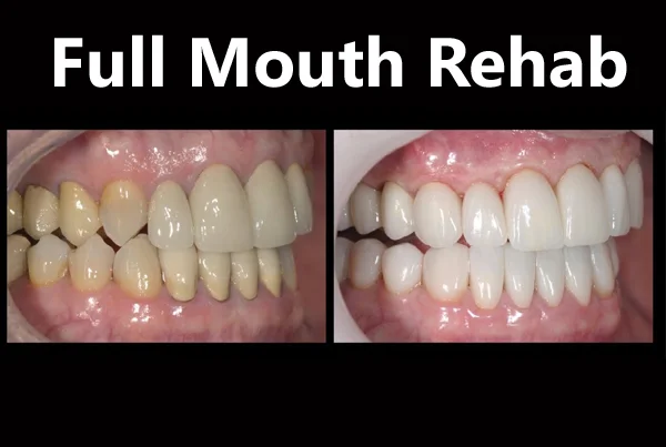Full Mouth Rehab